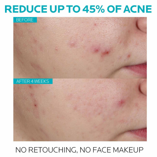 effaclar salicylsäure-serum gegen akne 15 salicylsäure-serum zur behandlung von akne